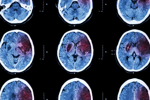 Bild på röntgade huvuden där skador av stroke syns. 